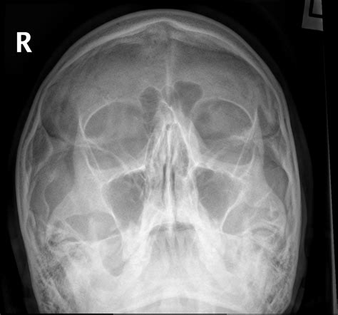 Pns Anatomy Radiology