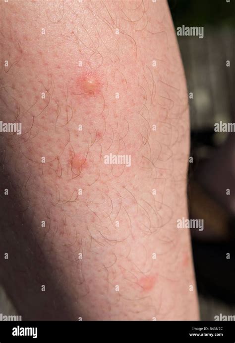 Mosquito bites on leg Stock Photo - Alamy