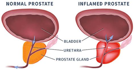 Benign Prostatic Enlargement (BPE) | The Urology Partnership