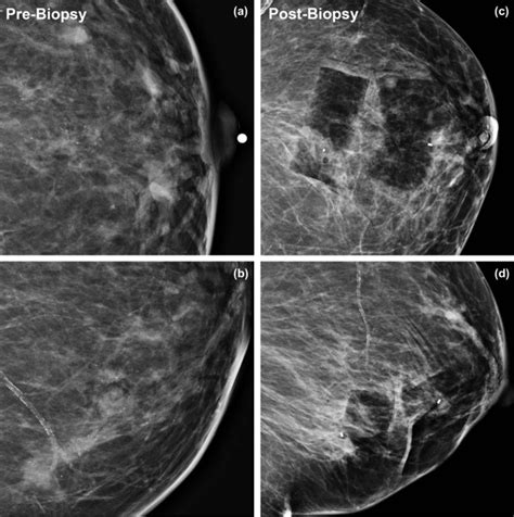 Stereotactic Biopsy of Segmental Breast Calcifications - Academic Radiology