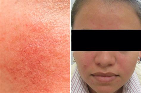 Rosacea vs. Psoriasis vs. Eczema: What's the Difference? | The Healthy