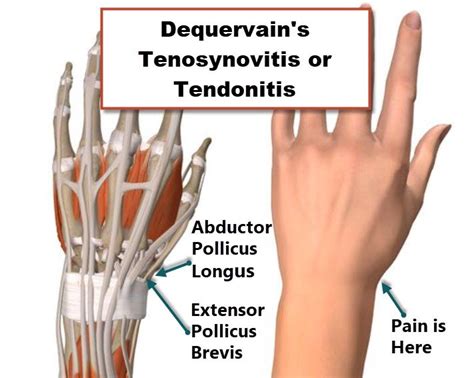 Extensor Tendonitis Wrist