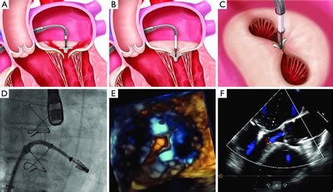 Standard steps of the MitraClip procedure. (A) Perpendicular... | Download Scientific Diagram