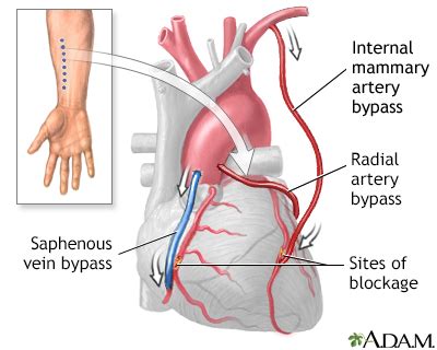 Heart bypass surgery - series