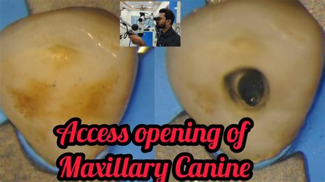 Access opening of Maxillary Canine step by step demonstration# rct for beginners #rct# ...