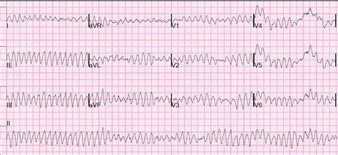 Dr. Smith's ECG Blog: Ventricular fibrillation on a 12-lead ECG