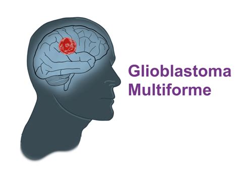 Glioblastoma Multiforme: the deadliest brain tumor - Pro doctor