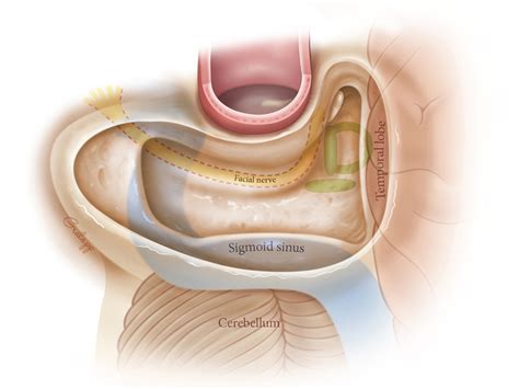 Intact Canal Wall Mastoidectomy – Oto Surgery Atlas