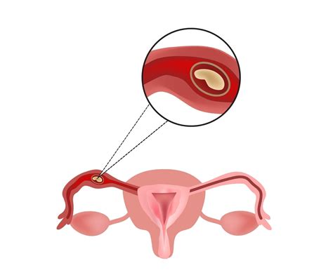 What Is Ectopic Pregnancy? Tubal Pregnancy | familydoctor.org