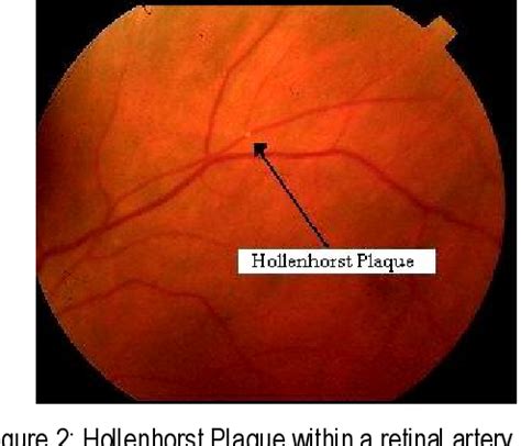 Amaurosis Fugax- A Clinical Review | Semantic Scholar