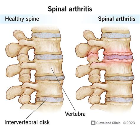 Spinal Arthritis: Symptoms & Treatment