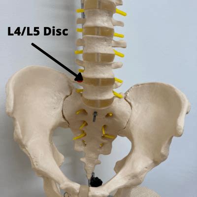 Bulging Disc L4/L5 - Symptoms and Treatment (2022 Complete Guide) (2022)