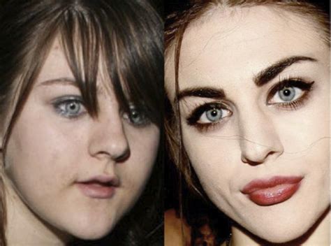 Frances Bean Cobain Plastic Surgery Before And After Photos | Plastic surgery, Botox fillers ...