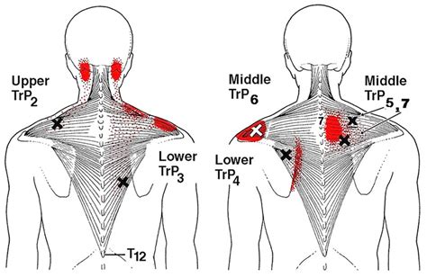 Trigger Point Injections - Tim Manahan’s Osteopathic Services