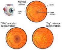 Avastin vs Lucentis, Eylea Injections Cost, Side effects