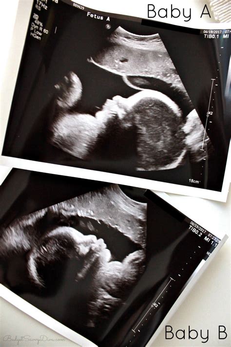 34 Week Twin Ultrasound | Budget Savvy Diva