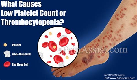 What Causes Low Platelet Count or Thrombocytopenia? | Low platelet count, Low platelets, Platelets