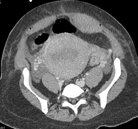 Post Partum Complications Including Pancreatitis and SBO / CTisus.com ...