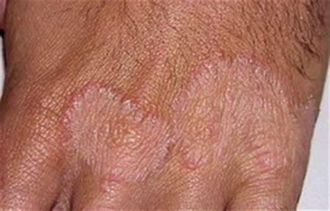 Hand Fungus – Symptoms, Causes, Pictures and Treatment : Health Blog