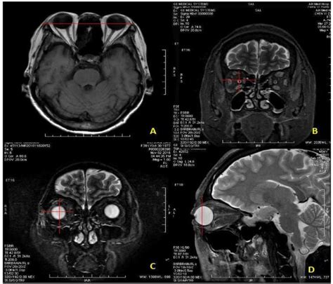 a: the orbital septum was used for differentiated location of anterior ...