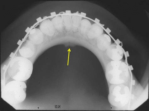 Anatomy on Radiographs: Occlusal Radiographs – Dr. G's Toothpix