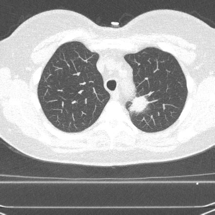 Lung-RADS | Radiology Reference Article | Radiopaedia.org