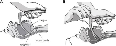 Endotracheal Intubation Steps