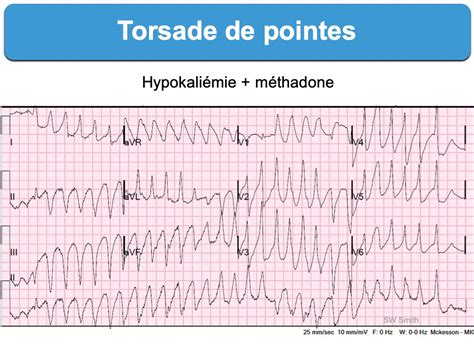 Torsade de pointes : e-cardiogram