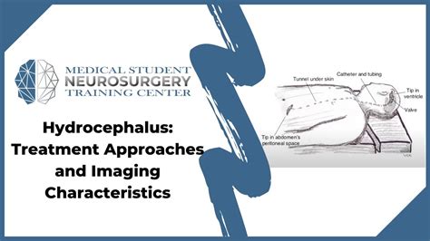 Hydrocephalus: Treatment Approaches and Imaging Characteristics - YouTube