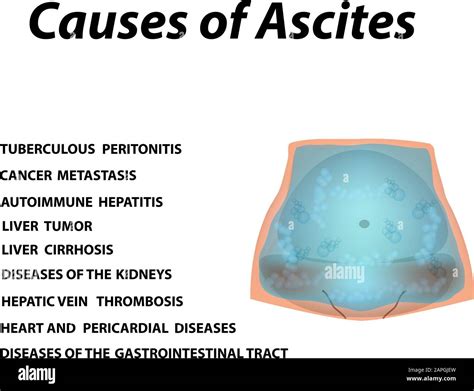 Ascites Causes Pictures Symptoms And Treatment