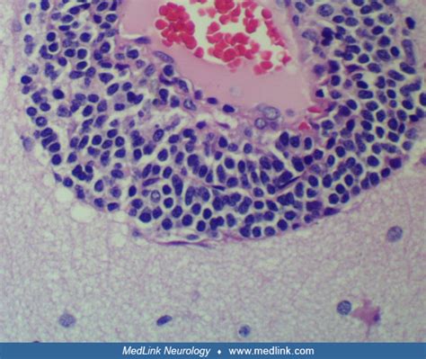 Rasmussen syndrome | MedLink Neurology