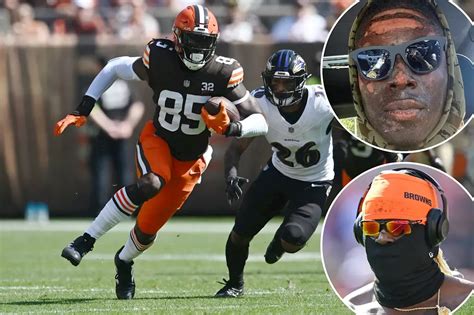 Browns' David Njoku reveals intense facial burns he suffered in nasty fire pit accident | United ...