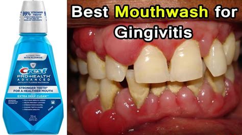 11 Best Mouthwashes For Gingivitis In 2023, 60% OFF