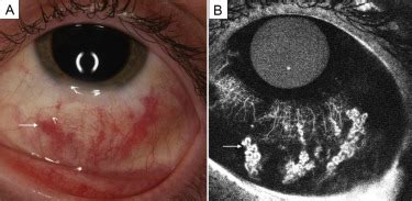 Episcleral racemose hemangioma - Journal of American Association for Pediatric Ophthalmology and ...