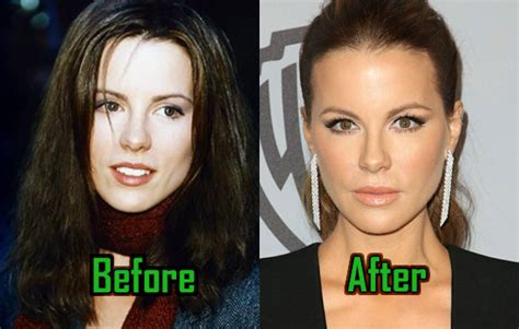 Kate Beckinsale Plastic Surgery: Nose Job, Botox, Before & after ...