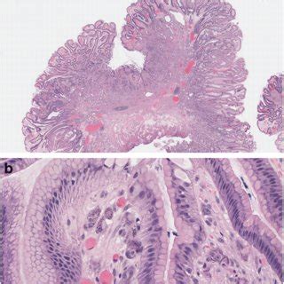 Reactive gastropathy as seen with NSAIDs ingestion with typical... | Download Scientific Diagram