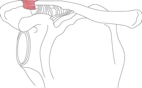 AC Joint Arthrosis - Shoulder Clinic