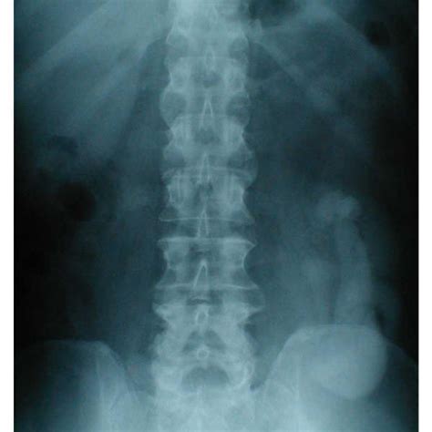 Lateral view of cervical spine shows congenital fusion of bodies of C2 ...