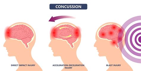 Can You Get a Concussion Without Hitting Your Head? – Dispelling Common Concussion Myths ...