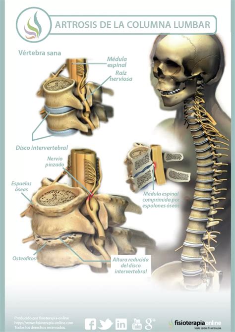 Artrosis lumbar: Qué es, causas, síntomas, tratamiento y consejos ...