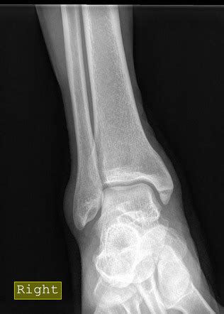 Medial malleolus fracture | Radiology Case | Radiopaedia.org