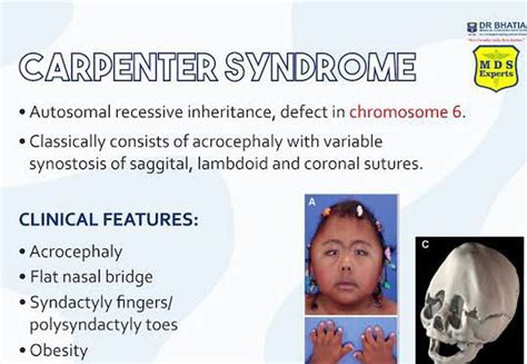 These are the features of Carpenter syndrome - MEDizzy