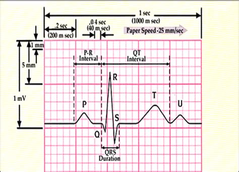 Ekg ecg interpretation – Artofit