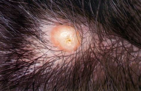 Ingrown Hair Follicle Cyst