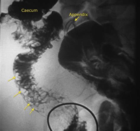 Crohn Disease - Barium Follow Through - Radiology at St. Vincent's University Hospital