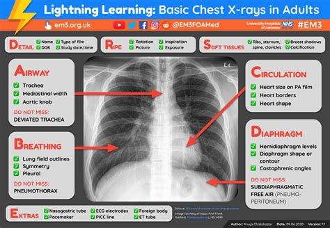 Lightning Learning: Basic Chest X-rays in Adults — EM3