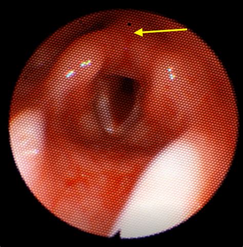 Cureus | Paradoxical Vocal Cord Motion Presaging Bilateral Vocal Cord ...