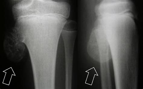 Osteochondroma causes, symptoms, diagnosis & osteochondroma treatment