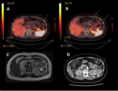 Frontiers | The Impact of 68Gallium DOTA PET/CT in Managing Patients With Sporadic and Familial ...