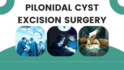 Know about pilonidal cyst excision surgery and incision surgery